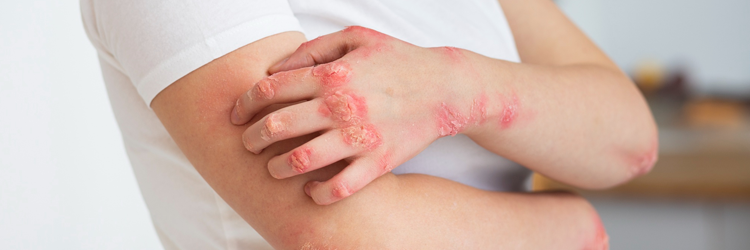 Psoriasis treatment