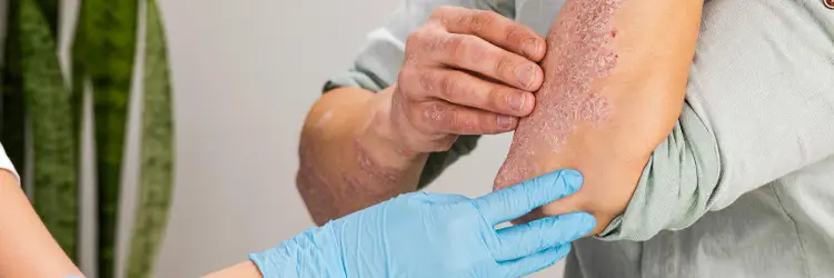 cure psoriasis permanently